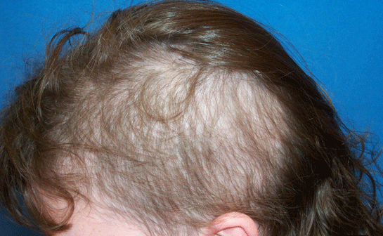 Saç yolma hastalığı olarak biliniyor en büyük nedeni stres! - Resim: 1